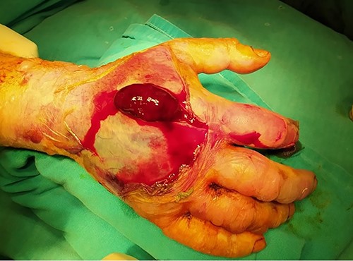 Hematoma along with fluid drained during the decompression.