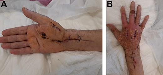 (A) Twenty-day postoperative view of the hand with tension-free skin closure. (B) Twenty-day postoperative view of the hand with tension-free skin closure.