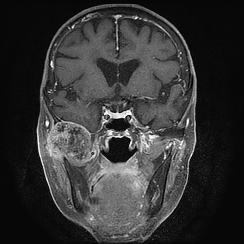Gadolinium-enhanced T1-weighted magnetic resonance imaging showing the TMJ mass compressing the bottom of the right temporal lobe of the brain.