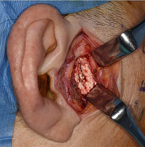 Intra-operative photograph showing a mass of white substance in the temporomandibular region.