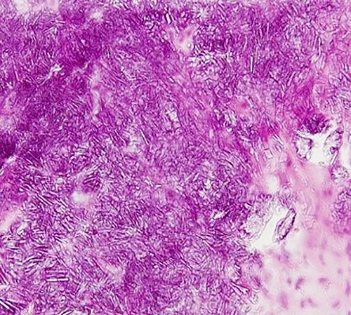 Photomicrograph showing lobular basophilic materials with variously sized rectangular or parallelogram-shaped crystals (haematoxylin–eosin stain, ×400).