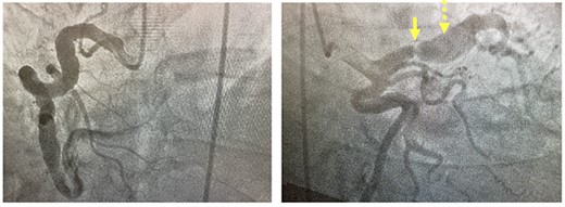 Coronary angiogram. Left panel: injection of fusiform aneurysm of right coronary artery. Right panel: coronary angiogram injection of the left-sided coronary circulation with solid yellow arrow pointing to tight left anterior descending stenosis and dotted yellow arrow pointing to post-stenotic aneurysm.