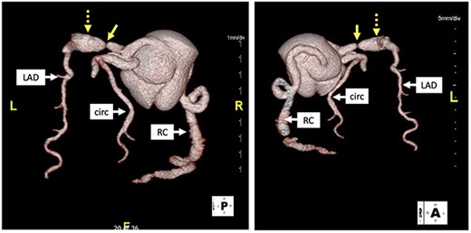 Computed tomography with 3D reconstruction. Solid yellow arrow points to tight stenosis in the left anterior descending and dotted yellow arrow points to post-stenotic aneurysm.