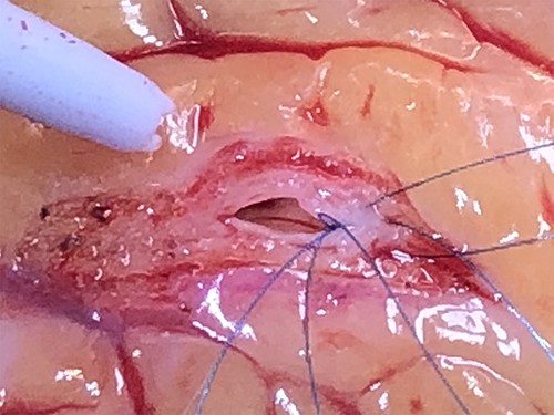 Intra-operative appearance of thickened and rubbery LAD.