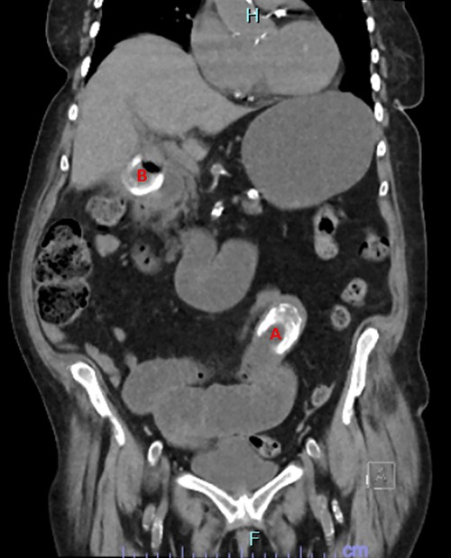 CT image showing obstructing gallstone (A) and gallstone in cholecystoduodenal fistula traversing duodenal wall (B).