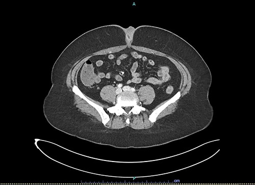Axial slice of contrast-enhanced CT scan showing umbilical soft tissue thickening and fluid-filled structure at presentation to emergency department.