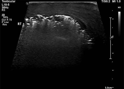 Ultrasound image of the right hemiscrotum showing gas bubbles causing acoustic shadowing and ringdown reverberation artifacts obscuring the deep tissue namely testicular parenchyma.