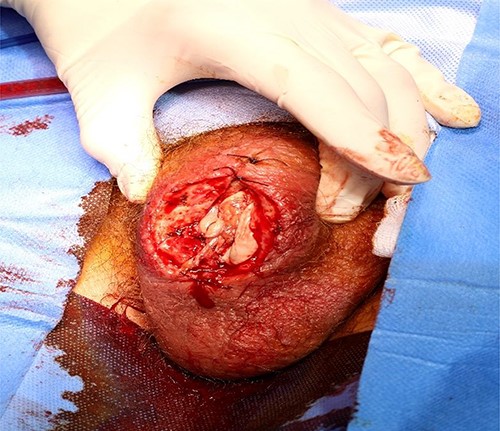 Post debridement picture showing healthy tissue with tunica albuginea stump of right testis.