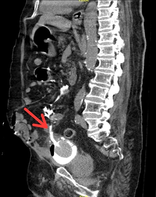 Sagittal view of CT scan showing Foley catheter protruding into peritoneal cavity.