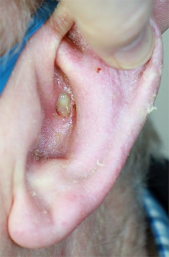 Ulcerated lesion on left ear prior to excision.