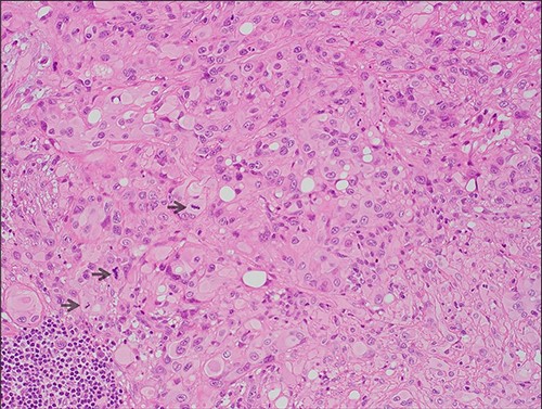 Microscopic features (x20, H&E) of the lesion which comprises of sheets of epithelioid cells with eosinophilic hyaline cytoplasm; intracytoplasmic lumina and focal pleomorphism are evident; mitotic figures are highlighted by arrows.