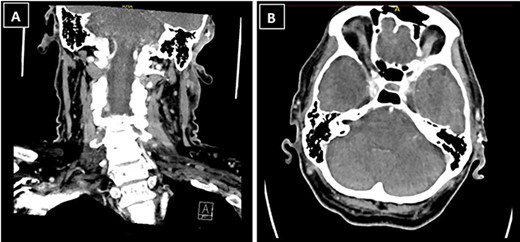 CT neck showed a 1.3 × 1.2 × 1.3-cm ill-defined soft tissue enhancement above the left external auditory canal involving the subcutaneous tissue and overlying skin; (A) coronal view; (B) axial view.