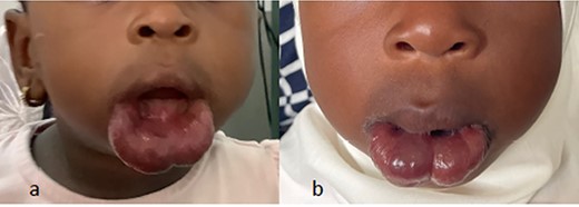 (a and b) Lower lip hemangioma before (a) and after (b) treatment with propranolol.