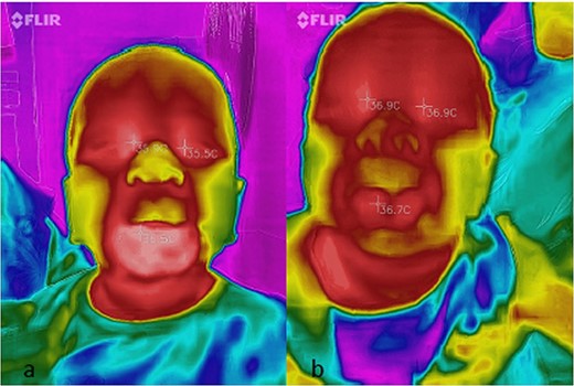 (a and b) Thermographic medial canthal and hemangioma temperature readings before (a) and after (b) commencement of oral propranolol.