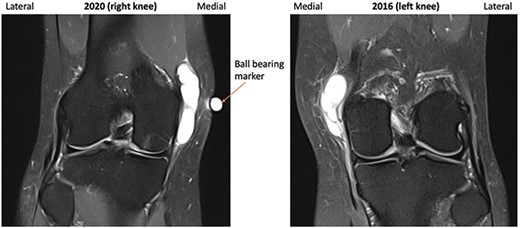 2016 and 2020 T2-weighted MRI in coronal plane with ganglion cyst visible medially.