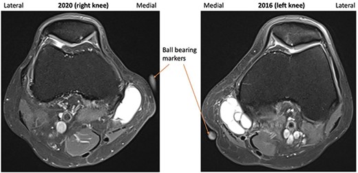 2016 and 2020 T2-weighted MRI in transverse plane with ganglion cyst visible medially.