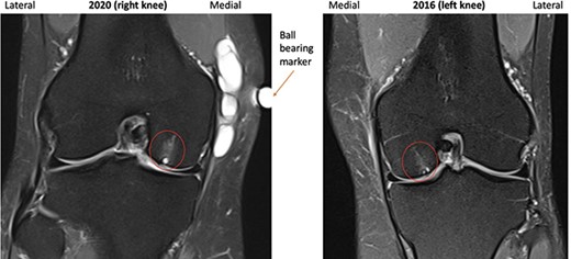 2016 and 2020 T2-weighted MRI in coronal plane with subchondral cyst circled medially.
