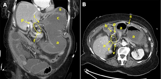Contrast-enhanced CT of the abdomen; the coronal slice (A) demonstrates the terminal ileum (i), dilated cecum (c) and ascending colon (a), which are abnormally positioned upside down in the lesser sac, herniated through the omental foramen (f); the portal vein (p) is compressed; the stomach (s) is displaced ventrally and cranially; the axial slice (B) shows the ascending colon (a) exiting the hernial orifice (f), which is located between the ventrally displaced common bile duct (b) and the inferior vena cava (v).