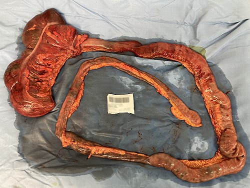 Intraoperative image.