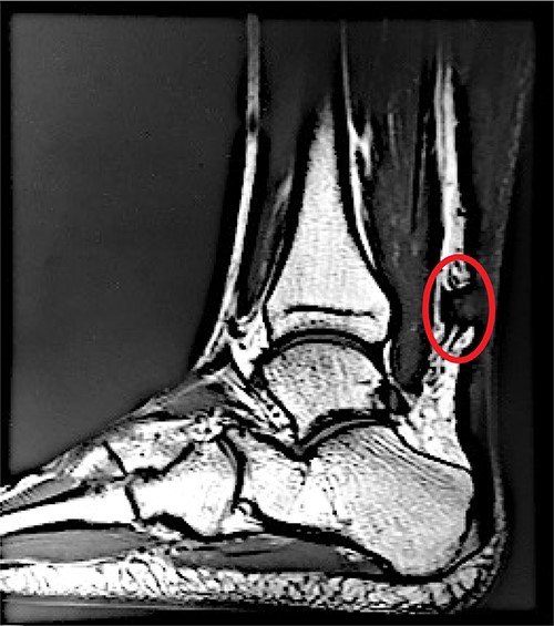 A sagittal view of the MRI of patient’s left Achilles demonstrates an acute, complete, Achilles rupture (circled in red) ~4 cm above the calcaneal insertion.