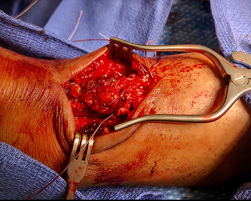 Intraoperative photograph demonstrating the open surgical technique utilized to repair the patient’s Achilles; initially, the proximal and distal stumps were debrided, controlled using Allis clamps and adequate excursion was noted with intraoperative testing; Krackow stitch was taken medially and laterally at the proximal stump and the distal stump with #2 FiberWire and the two edges of FiberWire were tied; #2 Orthocord was utilized to imbricate and reinforce with a Bunnell suture, followed by interrupted vicryl sutures; finally, the paratenon and subcutaneous tissue were closed in an interrupted fashion with vicryl sutures, while the epidermis was closed with interrupted nylon sutures.