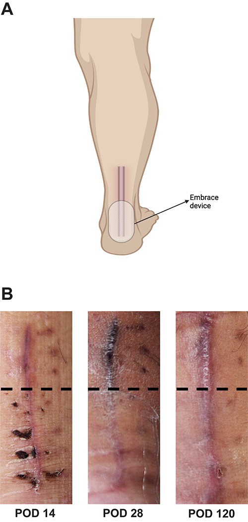 (A) Schematic representation of tension offloading device location and use during post-operative recovery from POD 14 until POD 120; (B) gross images of Achilles tendon repair incision prior to starting (POD 14), during (POD 28) and after completion (POD1 20) of treatment with the tension offloading device to the inferior portion of the incision; the middle panel (POD 28) demonstrates the patient actively utilizing the tension offloading device on the inferior portion of the incision; dotted black line demarcates non-treated scar (above the line) and treated scar (below the line).