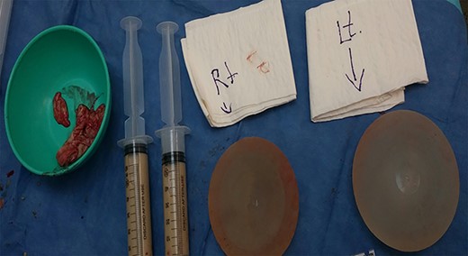 View of both breast implants after capsulectomy, specimen was taken from right breast implant and tissue for biopsy and specimen for culture.