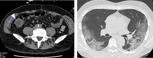 Plain CT on the 13th day after COVID-19 onset (the day after withdrawal from the ventilator); a cystic lesion was found in the right lower abdomen (arrowhead).
