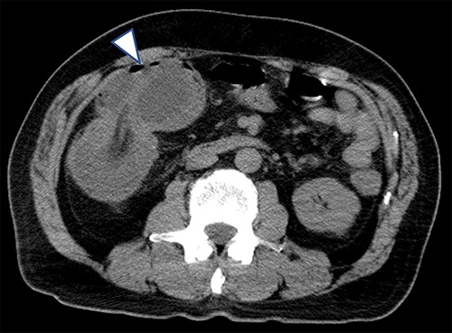 Plain CT taken when the patient was transferred to our hospital for abdominal pain; the cystic lesion had increased in size (arrowhead) and showed intussusception.