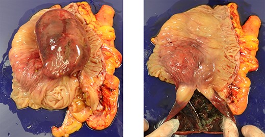 Excised specimen; there was a cystic lesion in the cecum, and the inner lumen of the cyst was necrotic.