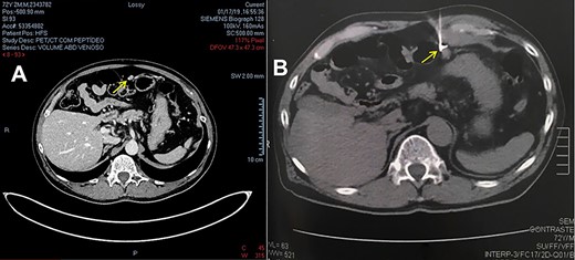 (A) CT image from PET-CT with PSMA-Gallium 68. (B) CT image of lesion marking with MAA-99mTc.