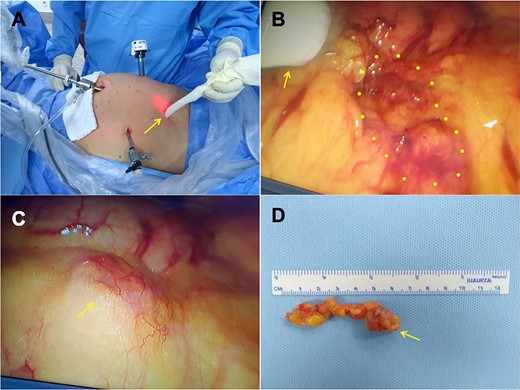 (A) The probe is localizing the lesion outside the abdominal cavity. (B) The arrow is pointing to the probe inside the abdominal cavity and the dotted circle shows the lesion. (C) Lesion seen by laparoscopy. (D) Removed lesion.