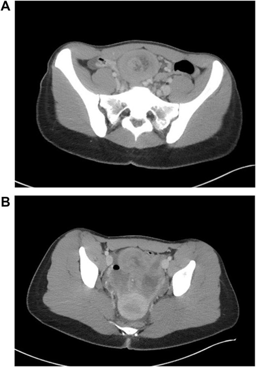 CT findings of long segment lead point.
