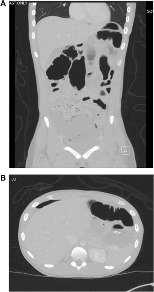 CT imaging with evidence of ascites and scattered pneumoperitoneum.
