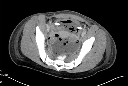 CT findings of pelvic fluid collection.