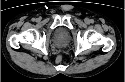 Abdominal computed tomography imaging. A groin hernia in the right inguinal region (arrow).