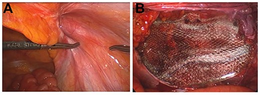 Intraoperative findings. (A) An indirect inguinal hernia, type L-2 according to the classification of the Japanese Society of Hernia. (B) The myopectineal orifice covered with a surgical mesh.