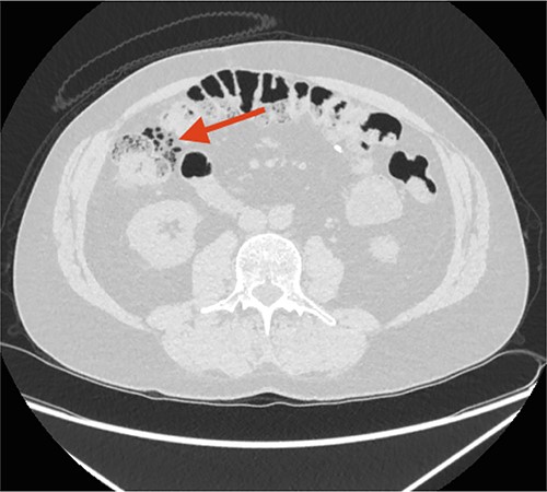 The initial CT scan. The arrow points at free intraperitoneal air (FIA) located along the right colon flexure.