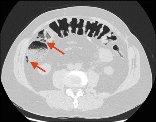 CT scan performed 2 days after the first admission to the Emergency Department (ED). The arrow points at remaining FIA along the ascending colon/right flexure.