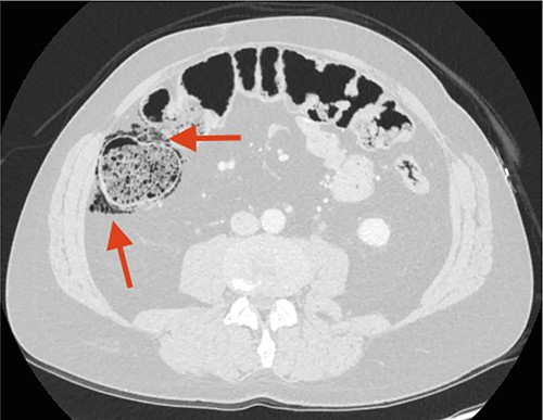 CT scan performed 3 months after the first admission to the ED. The arrow points at increased FIA and air bubbles in the colonic wall as signs of Pneumatosis cystoides Intestinalis, PCI.