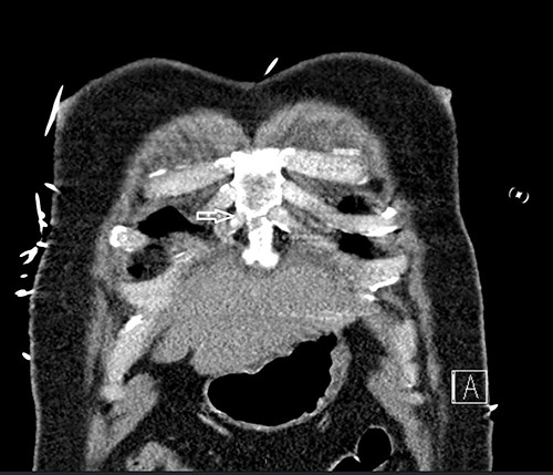 Computed tomography scan showing nondisplaced sternal body fracture (arrow).