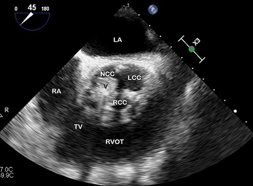 TOE, short axis demonstrating a vegetation (V) on the right coronary cusp (RCC; 11 × 8 mm) and on the non-coronary cusp (NCC; 15 × 11 mm); LCC, left coronary cusp; LA, left atrium; RA, right atrium; TV, tricuspid valve; RVOT, right ventricular outflow tract.