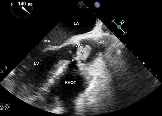 TOE, long axis demonstrating a vegetation (V) on the AV obstructing the left ventricular outflow tract; Ao, aorta; F, fistula; LV, left ventricle; MV, mitral valve.