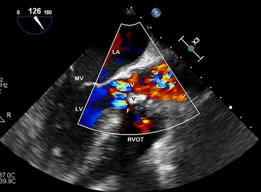 Preoperative TOE, long axis with colour flow highlighting the vegetation (V) obstructing flow through the AV and the fistula (F) which has developed from left ventricular outflow tract to RVOT.