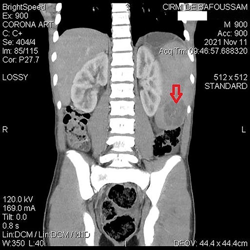 Abdominal CT demonstrating a contrast-enhanced hypodense mass in the spleen.
