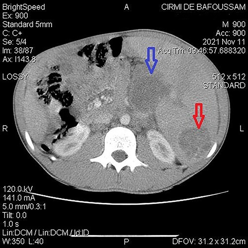 Abdominal CT demonstrating a cystic mass in tail of the pancreas (top arrow) and the tip of the spleen (bottom arrow).
