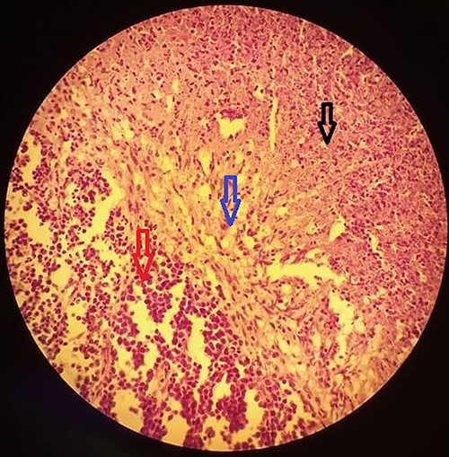 A section of the biopsy specimen showing a granuloma made up of lymphoid cells (left arrow), Langerhan’s giant cells and epithelioid cells (middle arrow) and caseous necrosis (right arrow); (hematoxylin and eosin stained technique, middle-multiplications).