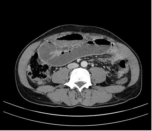 CT axial view: peritoneal thickening and mechanical ileus.