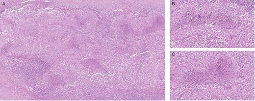 Histological finding of peritoneal biopsies showing extended granulomatous inflammation; necrosis in the center id multiple epithelioid granulomas; several multinucleated giant cells; hematoxylin and eosin staining, 5× magnification (A), 20x magnification (B, C).
