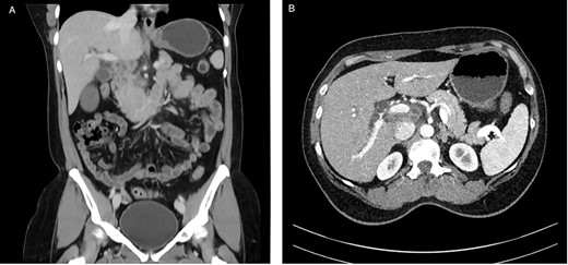 CT with contrast (A) coronal view and (B) axial view: cystic solid mass in the region of the hepatic hilus with unclear association to the head of the pancreas.